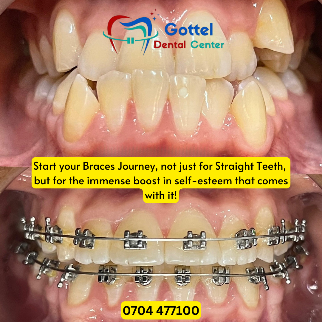 Braces transformation 4
